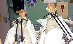 Image: Mark required multiple surgeries to repair and straighten his legs, which were shattered in the accident.